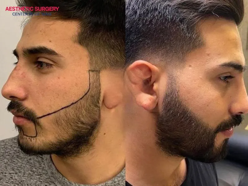 The cost of a beard transplant for men usually ranges from 25 to 45 million VND.