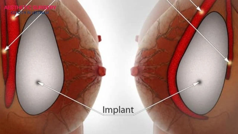 Submuscular implant placement is commonly preferred for transgender women to ensure adequate tissue coverage.