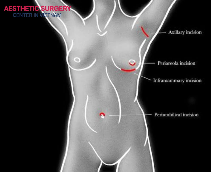Common incision sites for breast augmentation