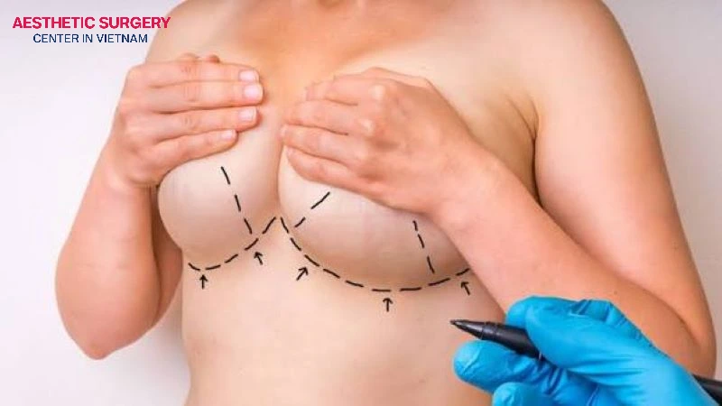 Among various breast augmentation incision types, an inframammary incision (an incision made in the crease under the breast) is suitable for large breast implants or cohesive gel implants.