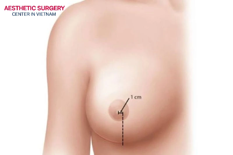 A periareolar incision is typically used when combining breast augmentation with a breast lift or a reduction of the areola.