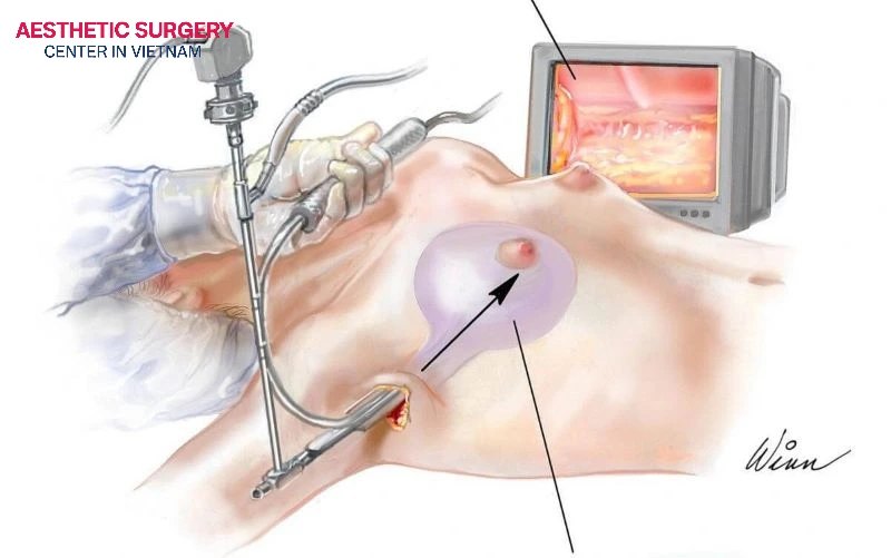 Among different breast augmentation incision types, the transaxillary incision—an approach through the armpit—typically leaves no scarring on the breast itself, making it a popular choice among women.