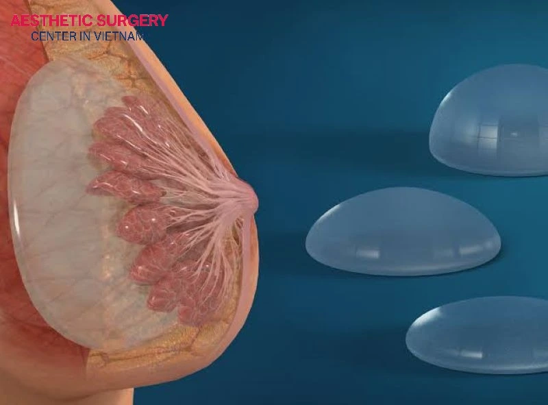 Under-the-muscle placement delivers a natural breast slope, markedly reduces capsular contracture, and preserves long-term stability.