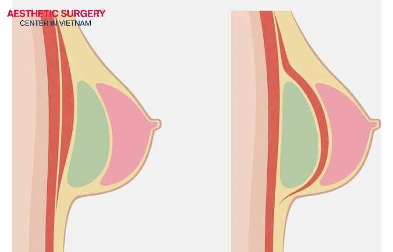 Recovery timelines and physical comfort differ noticeably between the two surgical approaches.