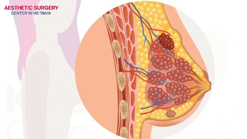 Sufficient tissue and subcutaneous fat permit subglandular placement while maintaining natural softness.
