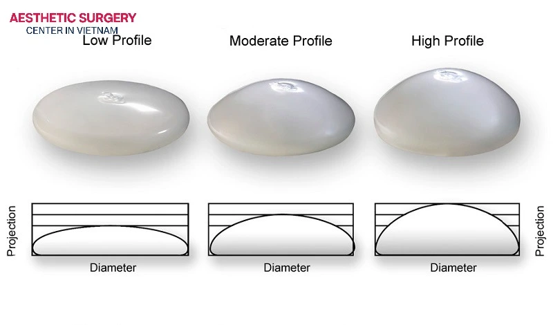 Implant dimensions and mass directly influence the ideal anatomical placement plane.