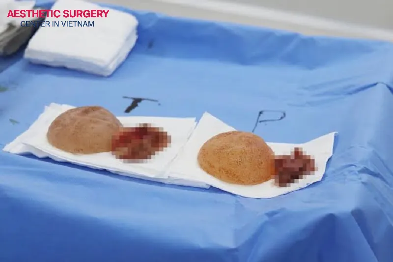 Capsulectomy provides definitive treatment for advanced capsular contracture and helps lower recurrence rates.