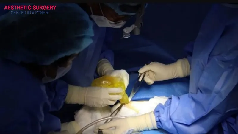 Capsulotomy releases capsule tension to expand the surgical pocket, allowing the implant to relax into place