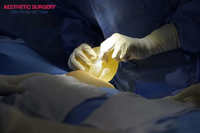Implant explantation or exchange restores a balanced, harmonious breast contour