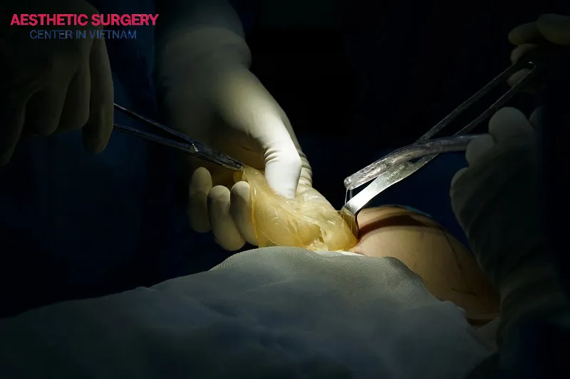 Breast implant removal surgery-without the placement of new implants—involves the complete extraction of existing breast implants from the body, with no other type of implant used as a replacement.