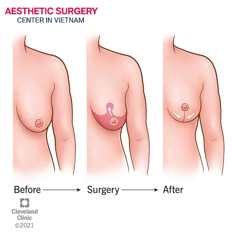 Combining breast implant removal with a breast lift procedure to restore a natural, well-contoured, and firm breast shape.