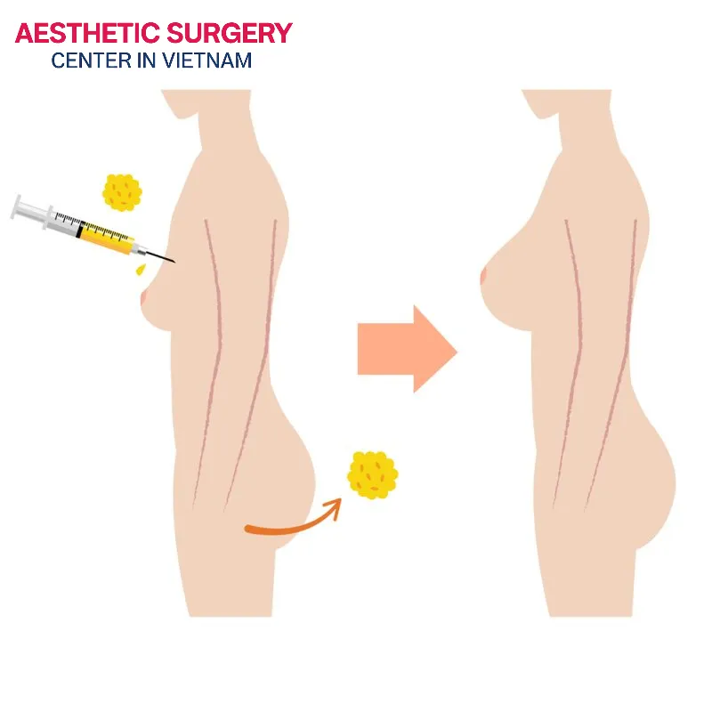 Autologous fat grafting is also a solution to help restore some of the lost volume, resulting in a fuller, more rounded breast shape.