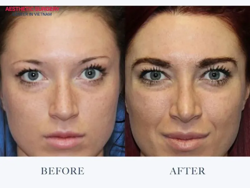 An eyebrow transplant is suitable for individuals with sparse or faded eyebrows.