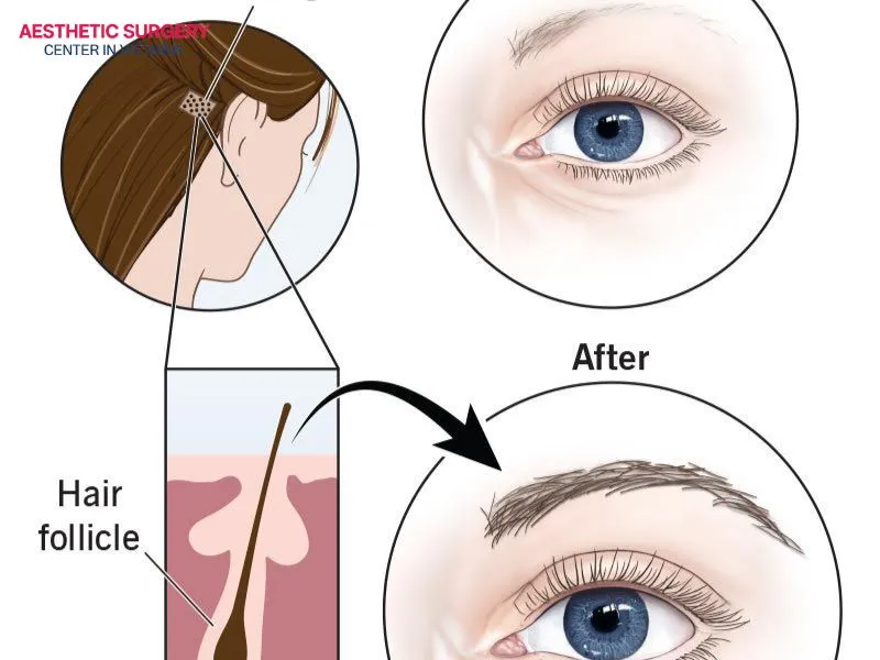 The FUE eyebrow hair transplant technique extracts each hair follicle individually, so it leaves less scarring.