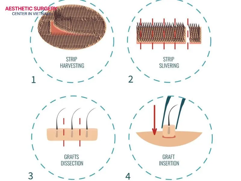 The FUT eyebrow transplant technique removes a small strip of scalp to collect hair follicles, so it usually leaves a short linear scar.