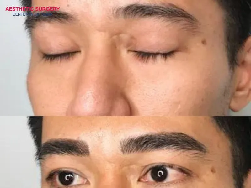 The cost of an eyebrow transplant depends on several factors, such as the number of follicular units needed and the patient's desired results.