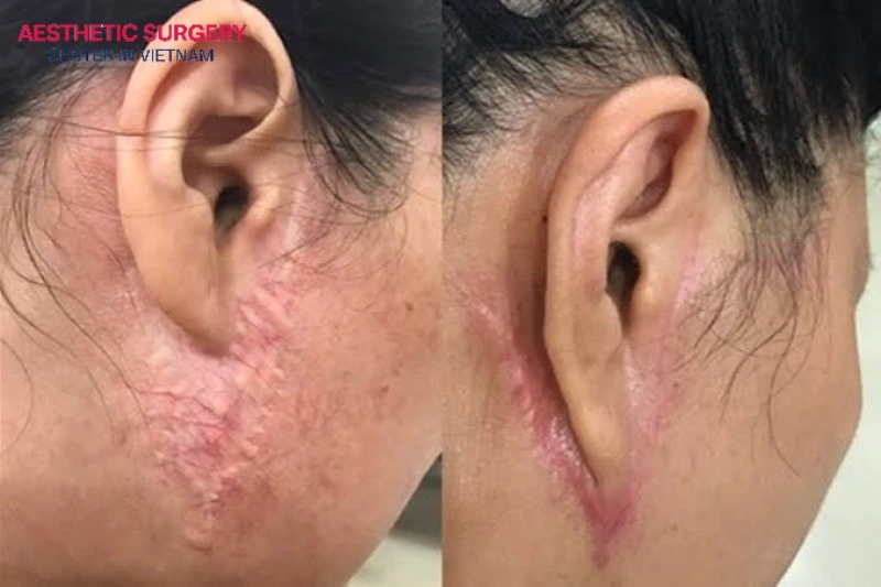 Facelift surgery may cause noticeable scarring if performed by an inexperienced surgeon.