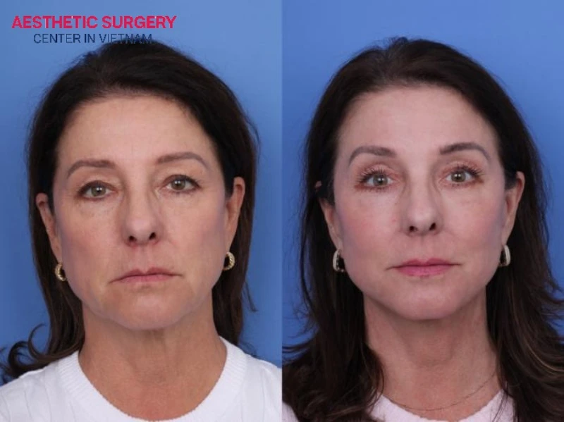 Facelift and blepharoplasty provide many benefits for facial rejuvenation.