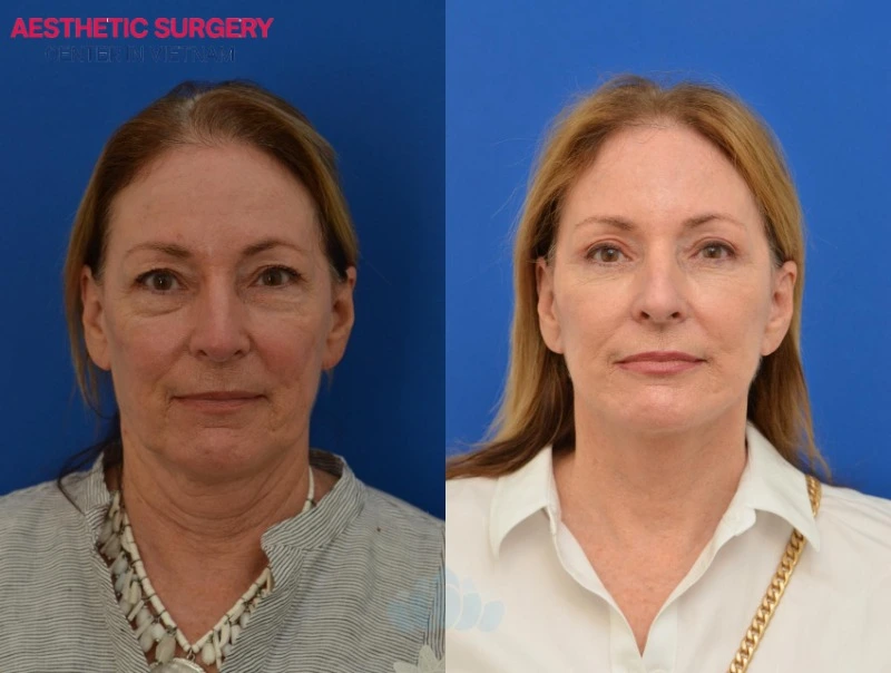 Individuals with facial wrinkles, sagging skin, drooping eyelids, excess eyelid skin, and large under-eye bags are suitable candidates for combining a facelift with blepharoplasty.