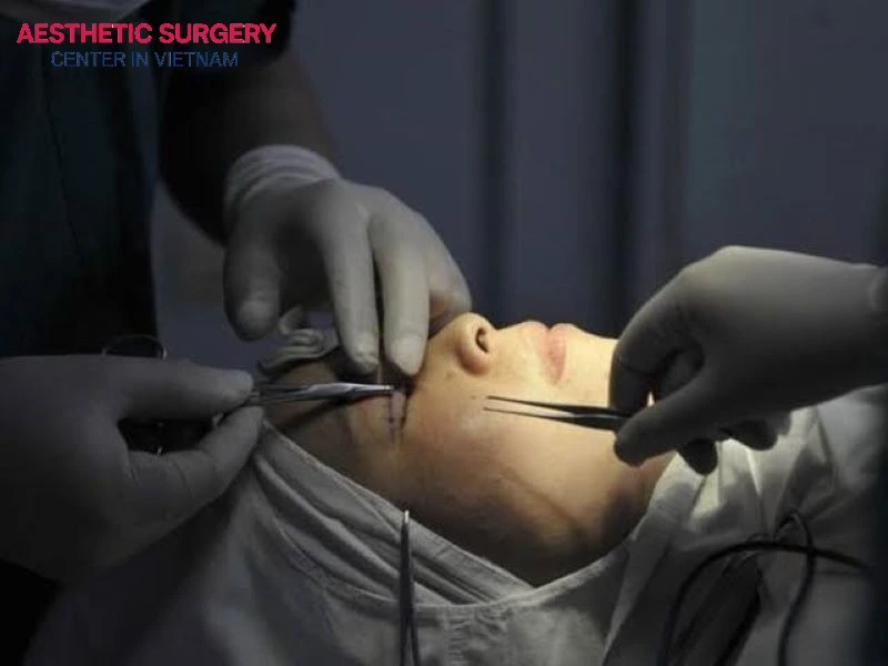 The surgeon will perform the eyelid surgery first and then proceed with the facelift.