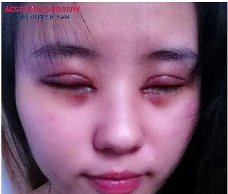 Facelift with blepharoplasty may cause some risks such as swelling, bruising, and mild pain.