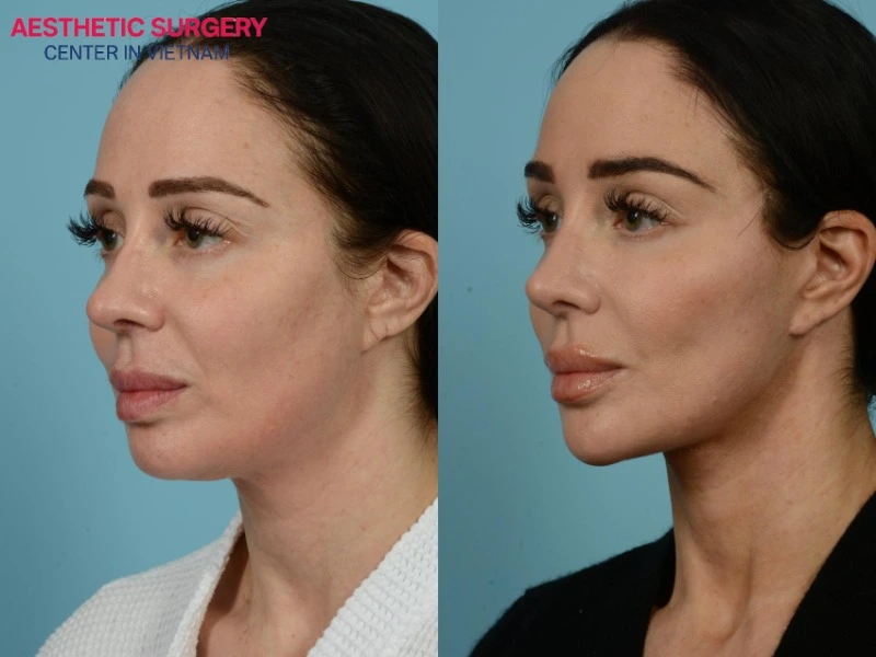 The facelift procedure can be combined with a Mini Facelift.