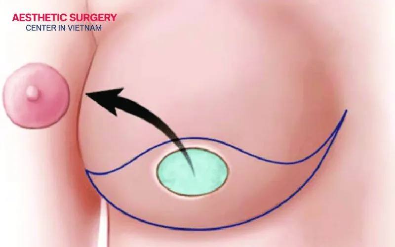 The surgeon separates the nipple-areola complex as a free graft, removes excess breast tissue, and carefully grafts it onto the center of the newly shaped breast.