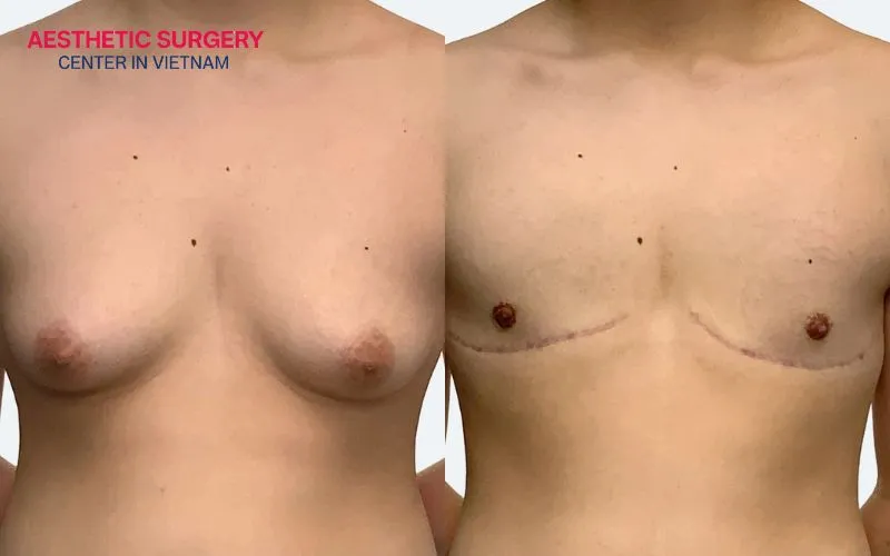 Free nipple graft breast reduction allows for maximum breast size reduction. It creates a smaller, flatter, and more balanced breast shape based on the desired result.