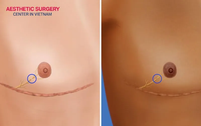 Reduced or complete loss of natural nipple sensation is a physiological change that is difficult to avoid after surgery.