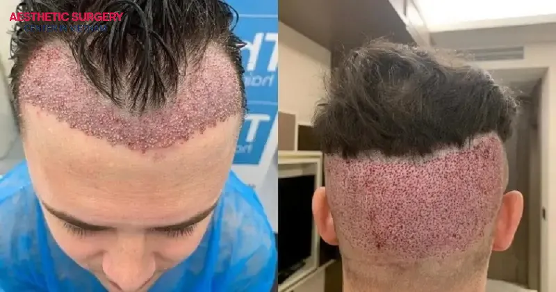 Hair shedding after a hair transplant is often caused by changes in the hair growth cycle and the side effects of anesthesia.