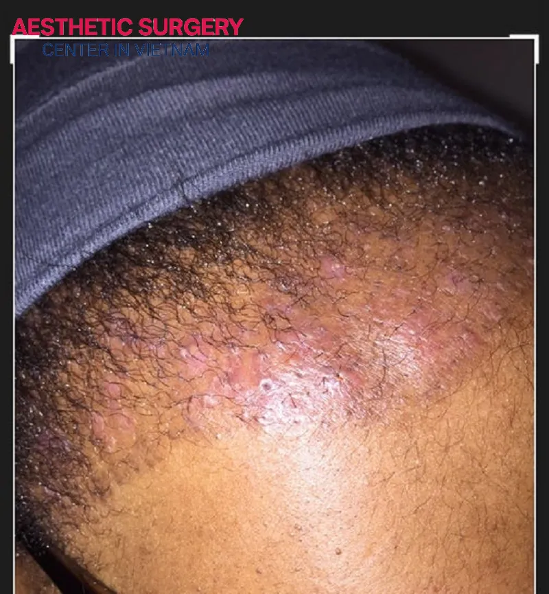 If you notice swelling, inflammation, or pus in the transplanted area, contact your doctor immediately for timely treatment.