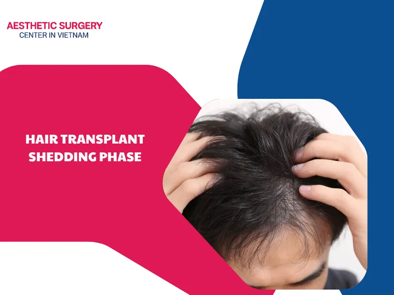 What is the hair transplant shedding phase? Why does it happen?