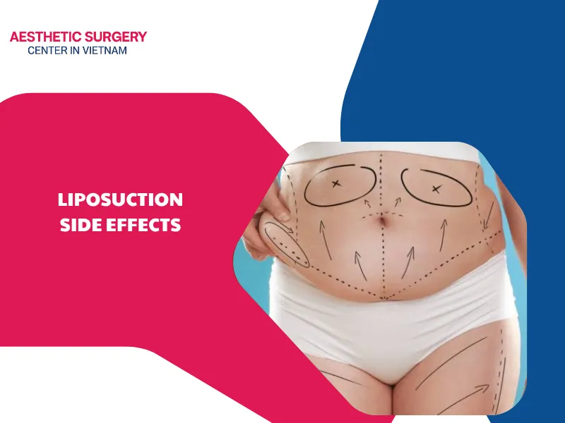 Notable liposuction side effects to understand before surgery