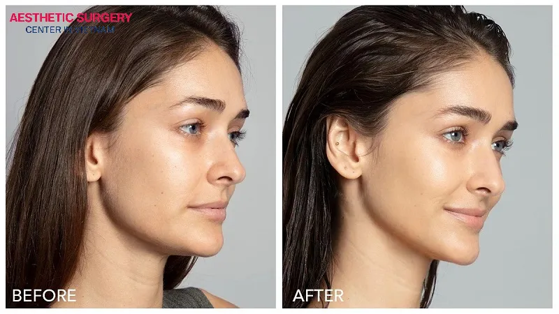 A microcurrent face lift helps define facial features, reduce fine lines and deeper wrinkles, and improve skin tone.