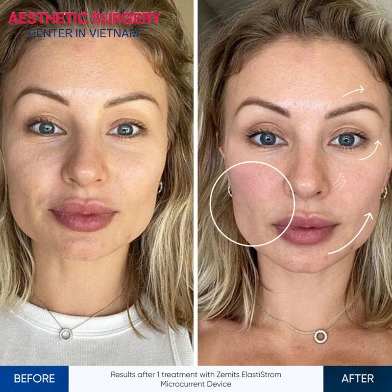 The jawline and cheek area show noticeable improvement after a microcurrent face lift treatment.