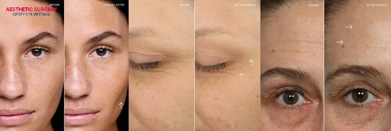 A microcurrent face lift helps improve the forehead and eye area.