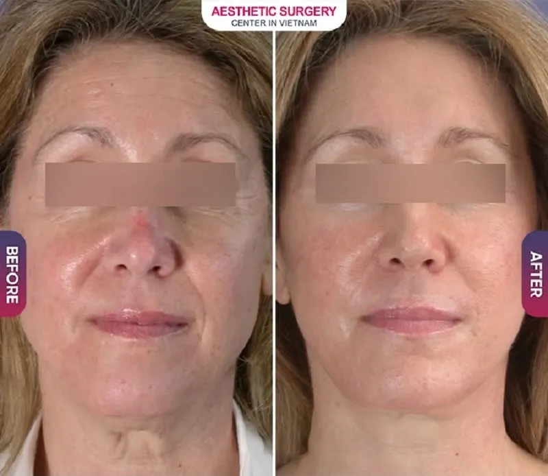 Customers who receive microcurrent face lift treatments at Aesthetic Surgery Center can reduce the appearance of wrinkles and achieve firmer, more radiant skin.