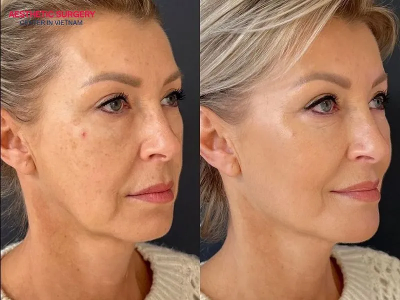 A mid-facelift is suitable for both men and women between the ages of 30 and 55.