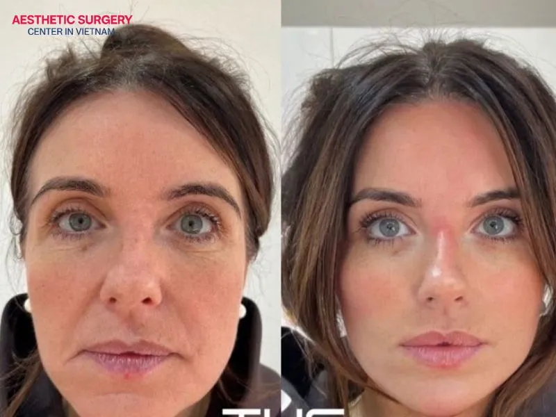 The cost of a mid facelift is affected by many factors.