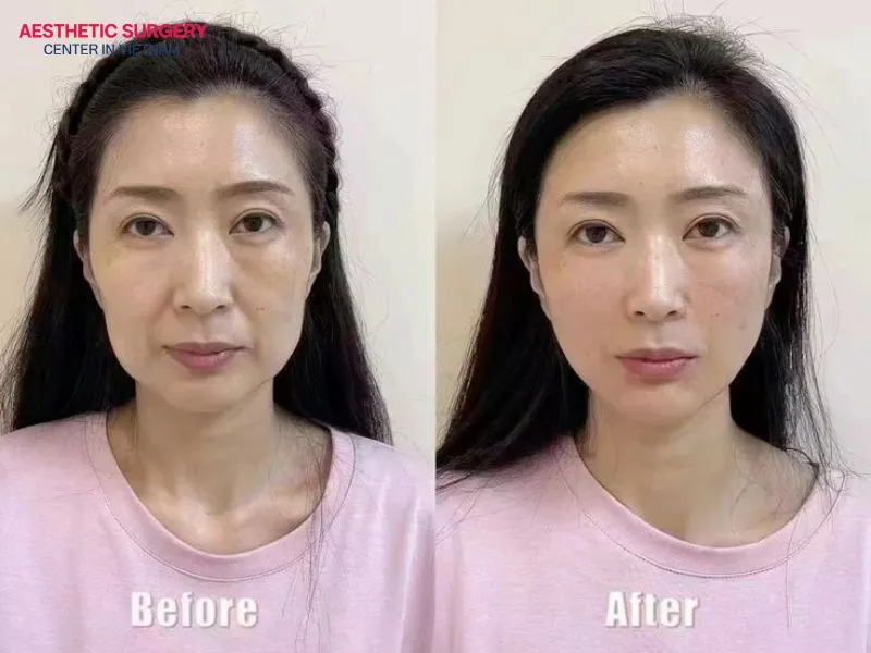 The mid facelift is considered a safe and moderately invasive aesthetic procedure.