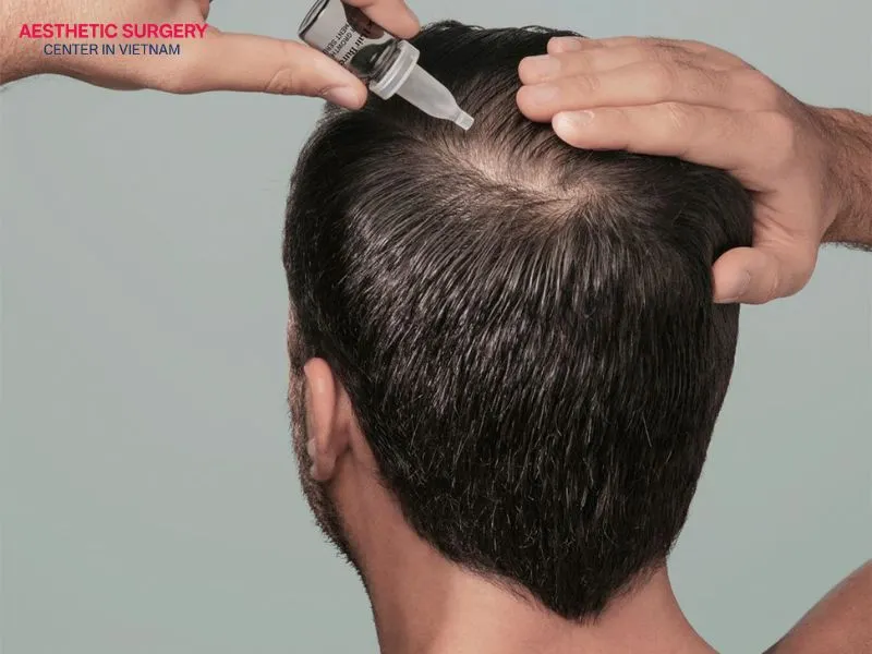 Minoxidil should be used from the fourth week after a hair transplant because the wounds around the transplanted hair follicles have healed by this time.