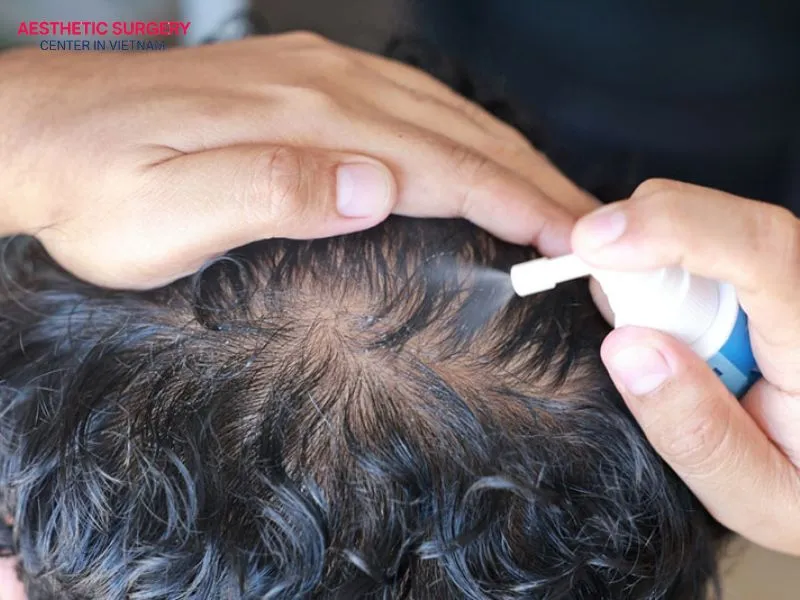 Minoxidil is considered a safe active ingredient and does not negatively affect newly transplanted hair follicles.