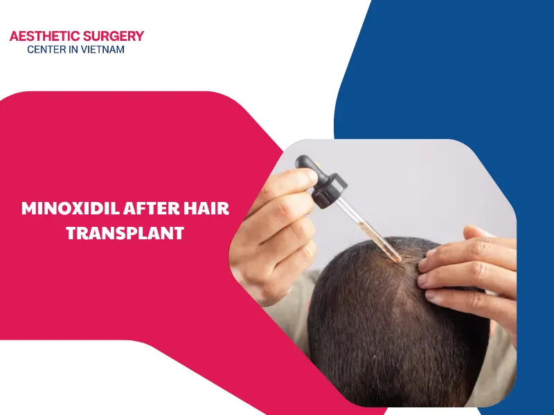 Using minoxidil after hair transplant: When and how to use it