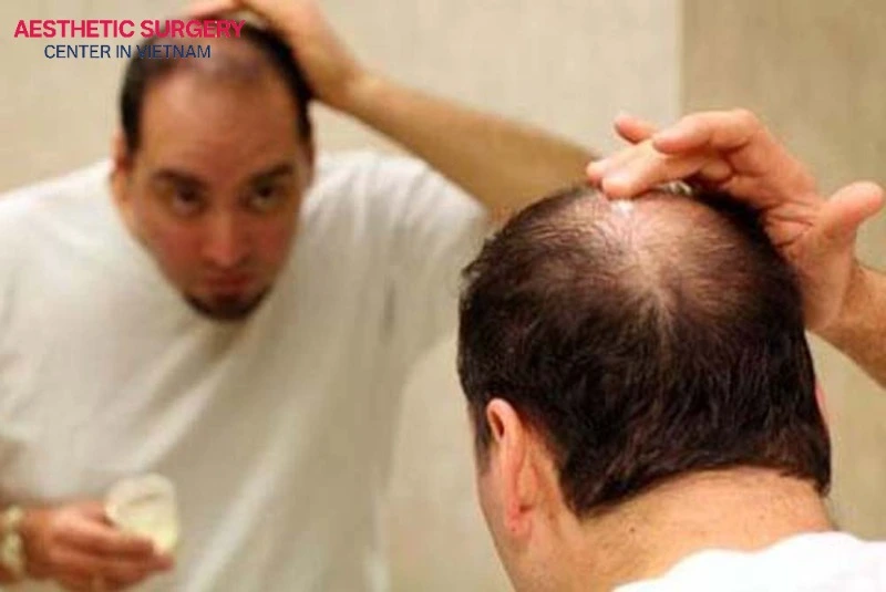 Smoking again too soon after a hair transplant can cause permanent hair loss and even scarring.