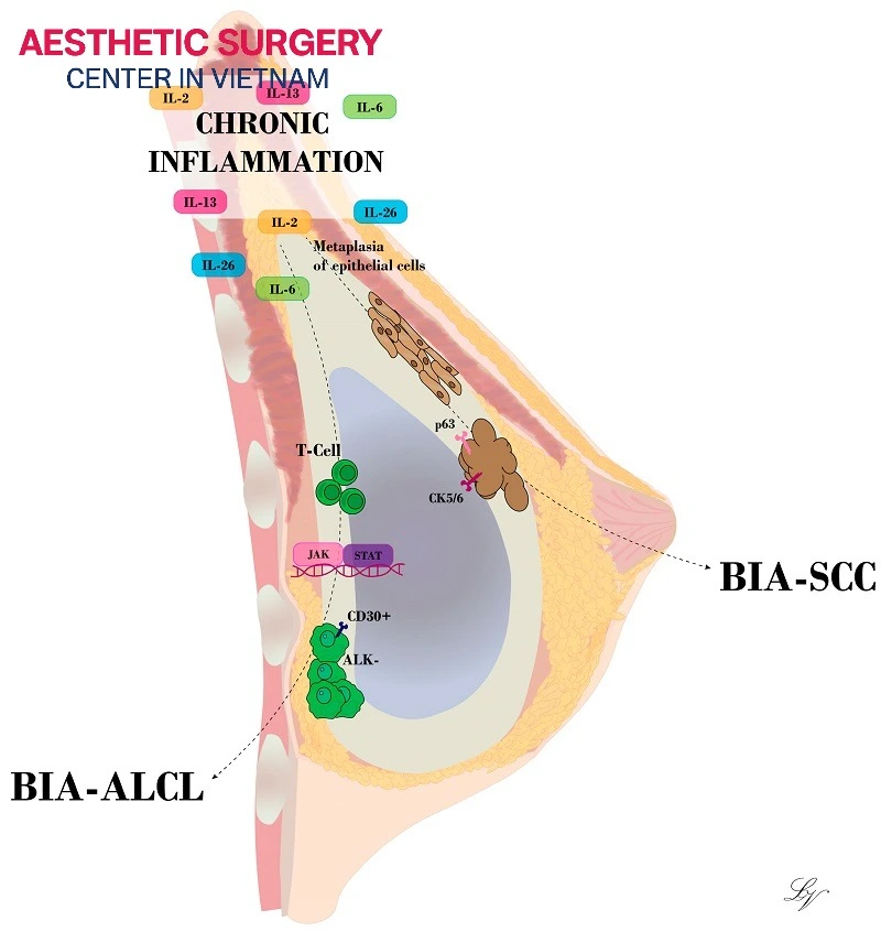 BIA-ALCL is an immune system lymphoma that develops in the capsule or fluid adjacent to an implant.