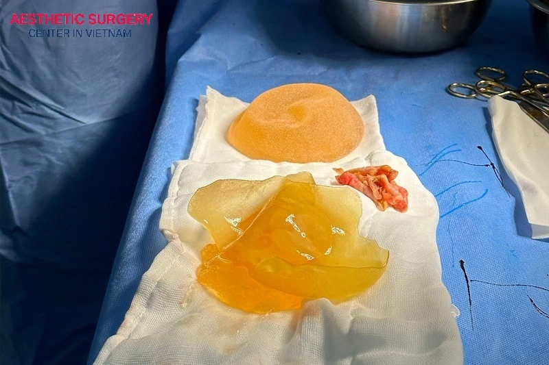 Capsular contracture risk is multifactorial and cannot be attributed exclusively to implant surface type.