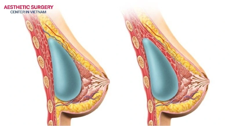 Surgical pocket plane selection determines the optimal implant surface and volume parameters.