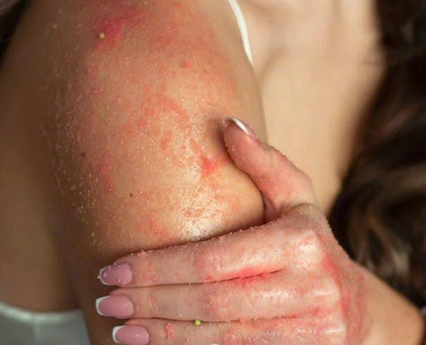 Những sai lầm phổ biến khi tắm trắng bia