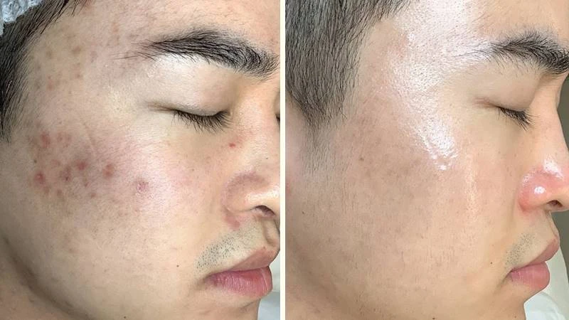 Peel da trị tàn nhang có gây tác dụng phụ không?