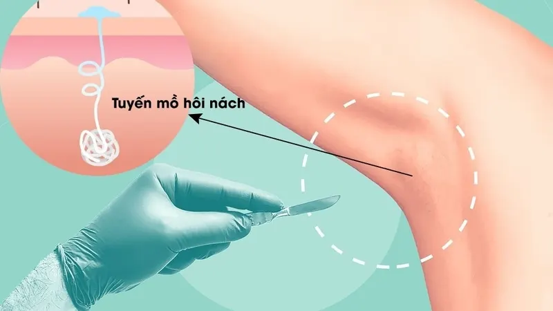 Tuyến mồ hôi nách là gì và tại sao cần loại bỏ?